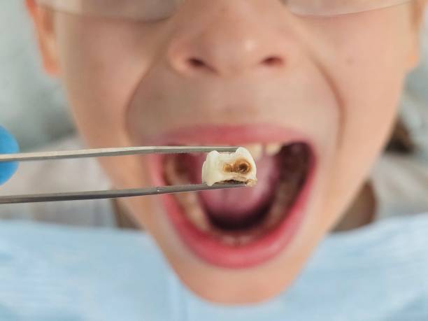 Best Emergency Wisdom Tooth Extraction in Gap, PA